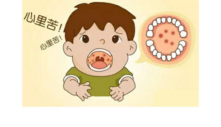 皰疹性咽峽炎高發(fā)，這些知識要了解！